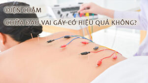 Điện châm chữa đau vai gáy có hiệu quả không