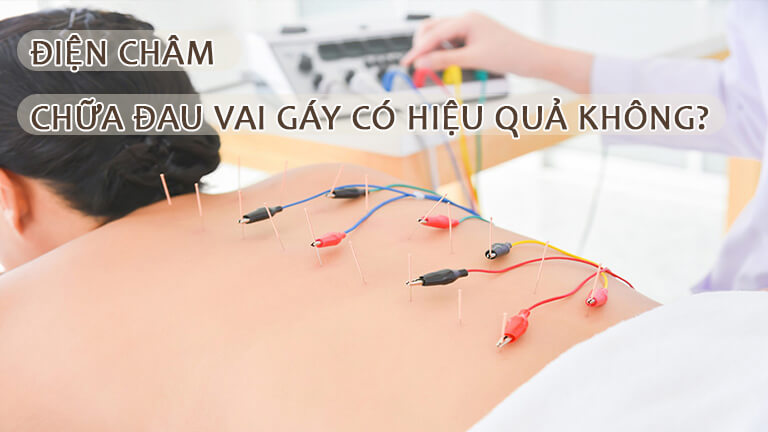 Điện châm chữa đau vai gáy có hiệu quả không